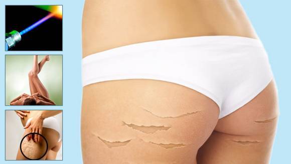 Лечение послеоперационных шрамов и растяжек